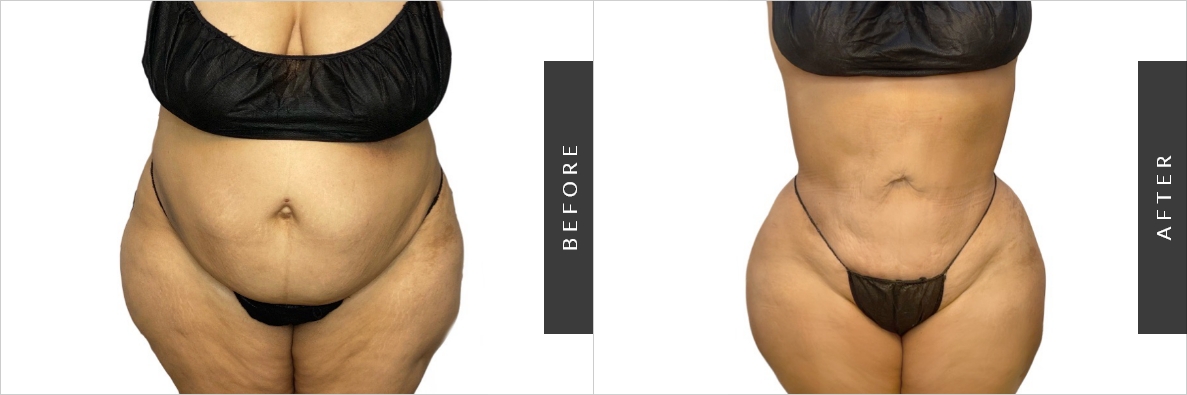 lipo cost lipo cost