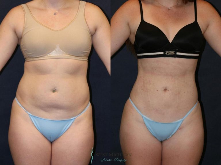 Lipo Cost: Budgeting for body contouring