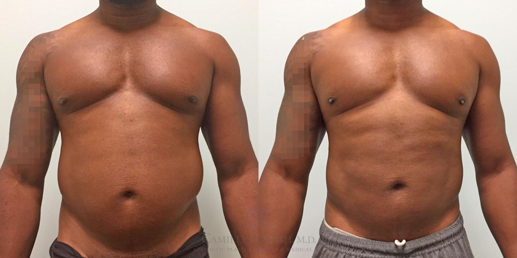 lipo for men