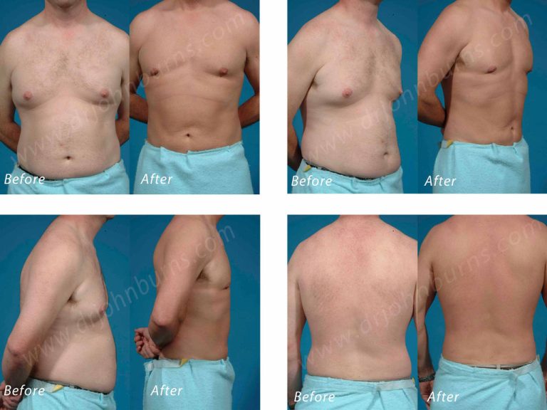 Lipo for Men: Tailored solutions for men