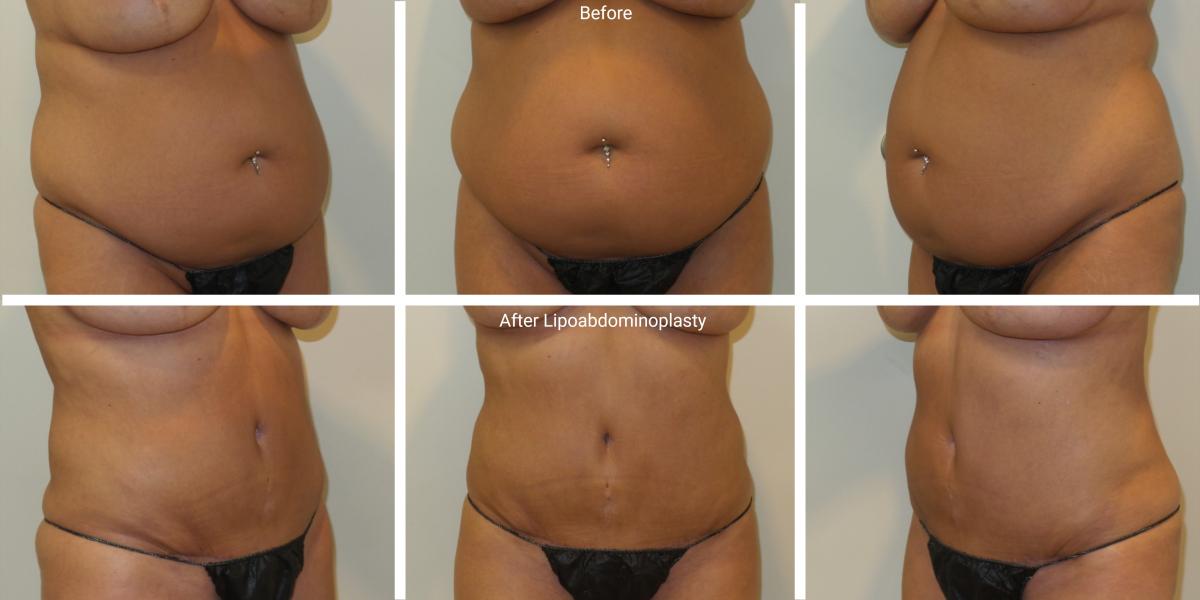 lipoabdominoplasty lipoabdominoplasty