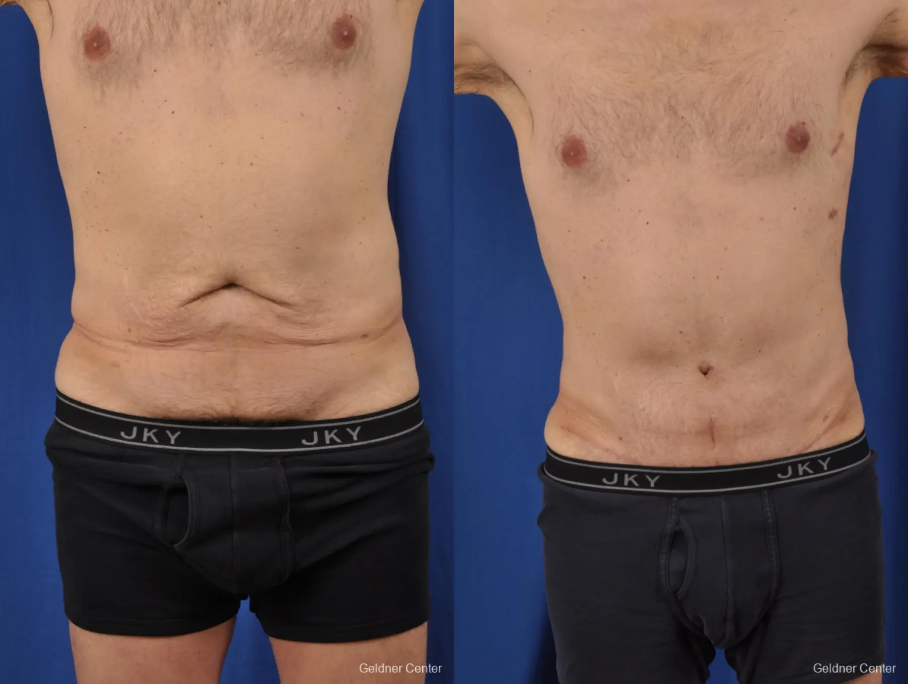 lipoabdominoplasty lipoabdominoplasty