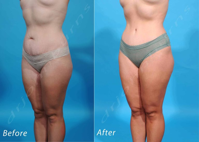 Lipoabdominoplasty: A Comprehensive Approach to Body Contouring