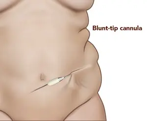lipoabdominoplasty lipoabdominoplasty