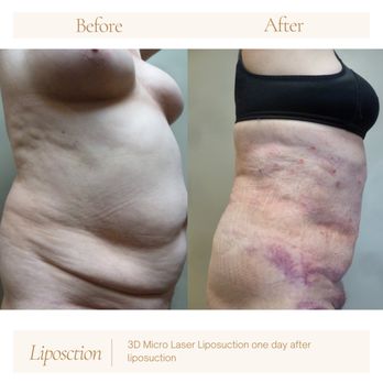 lipoplasty