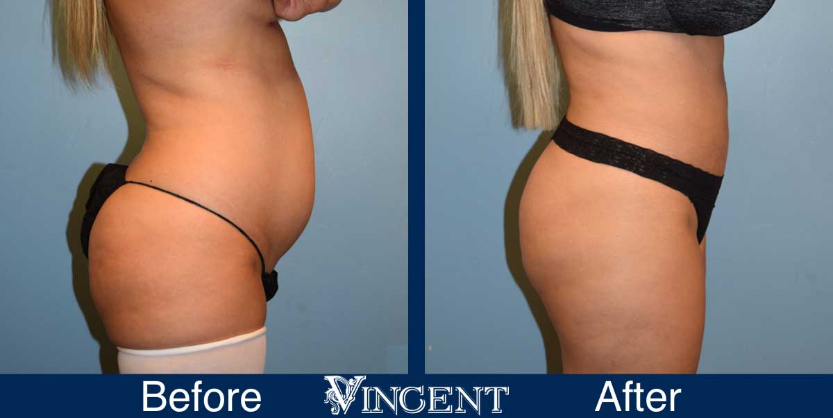 lipoplasty