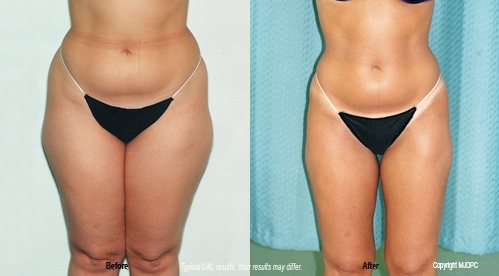 Lipoplasty: Precise fat removal