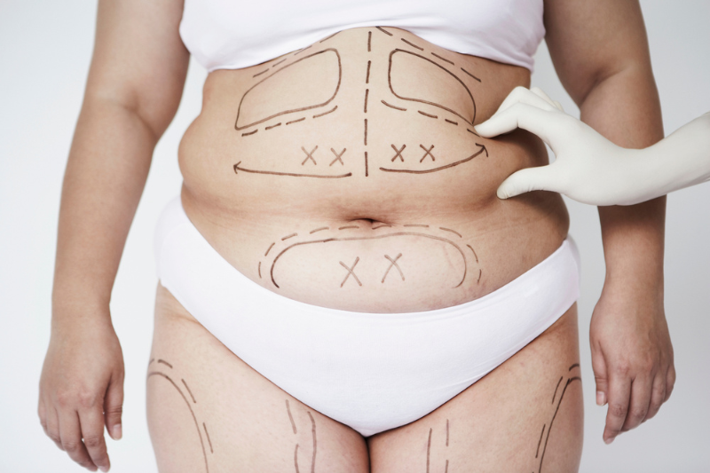 lipoplasty