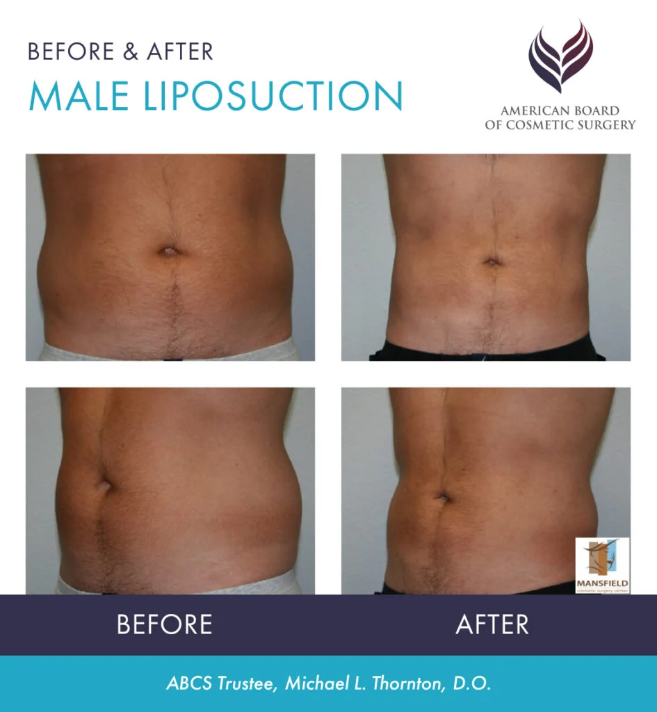 lipoplasty