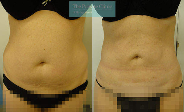 liposuction belly