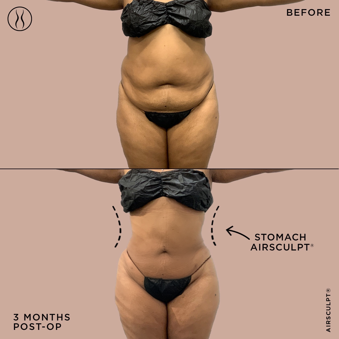 liposuction belly