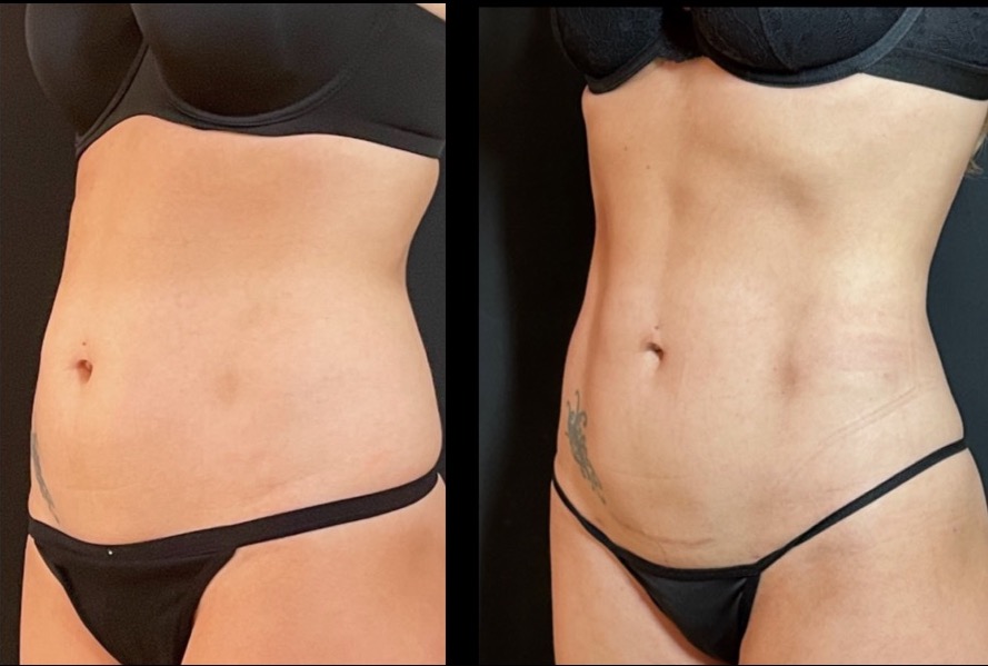 liposuction belly