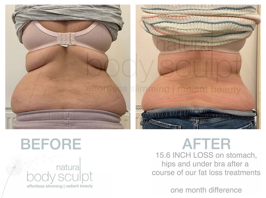 liposuction laser