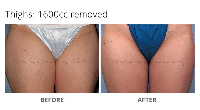 liposuction laser