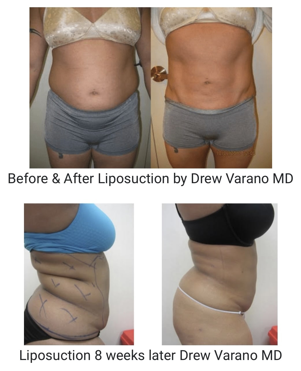 liposuction laser