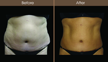 Liposuction Laser: Minimally invasive fat removal