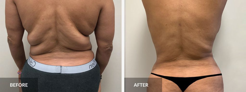liposuction price liposuction price