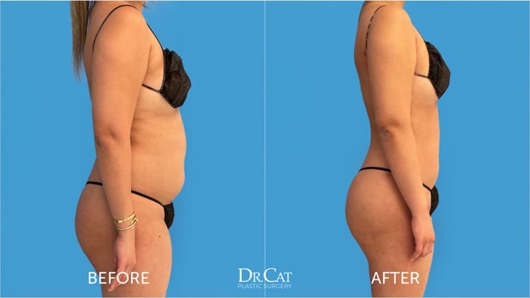 Liposuction Price: Breaking down the cost