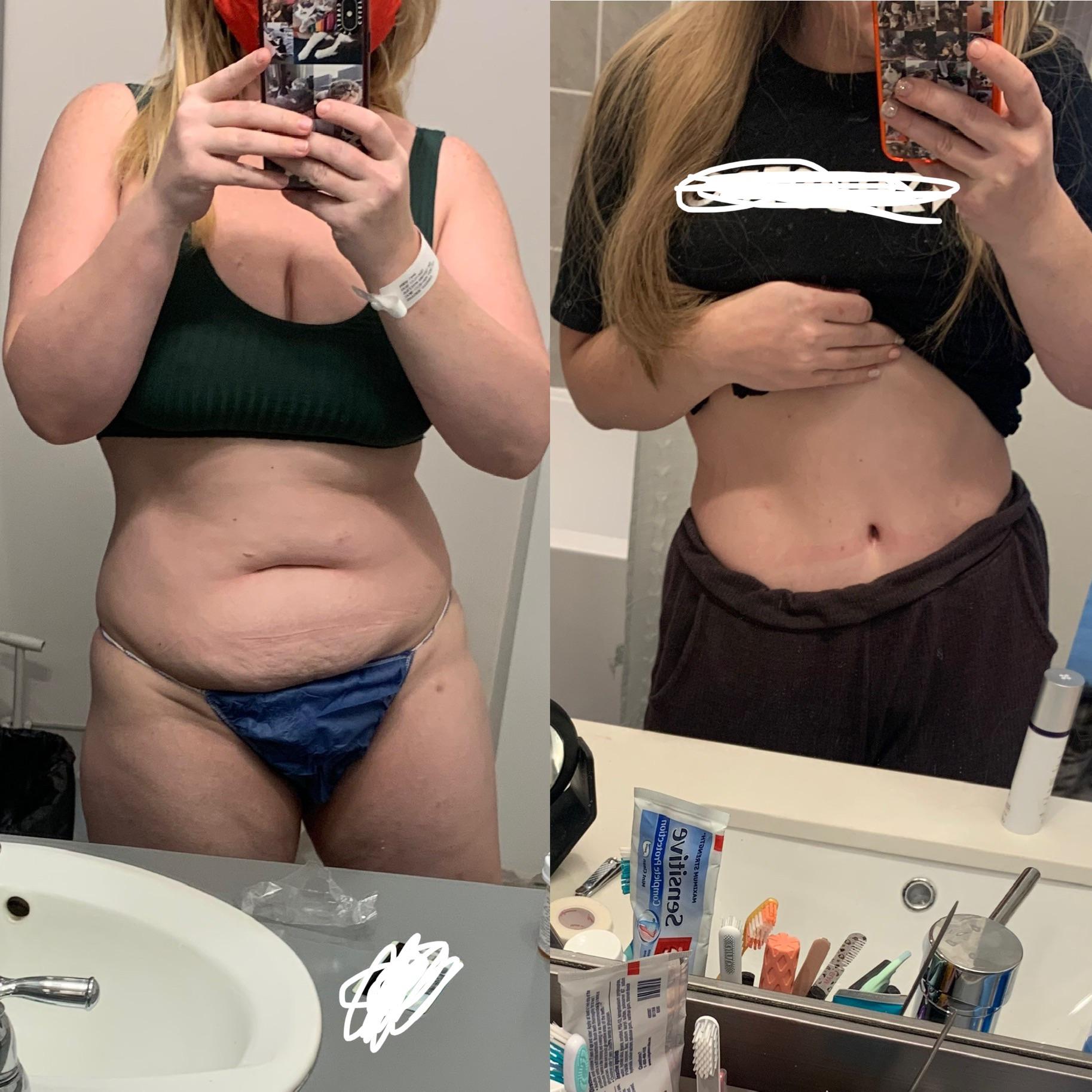 liposuction reddit