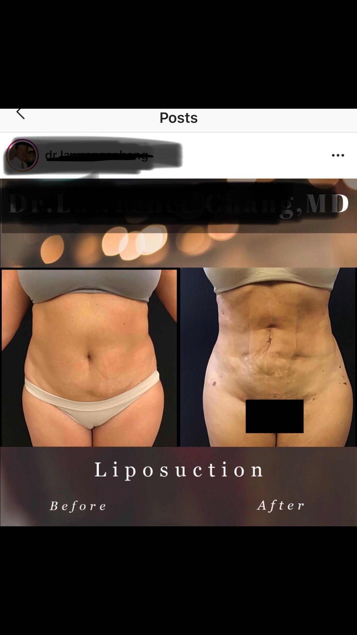 liposuction reddit