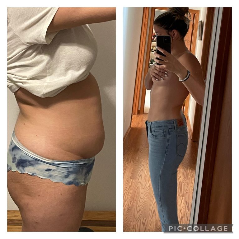 Liposuction Reddit: Insights and experiences