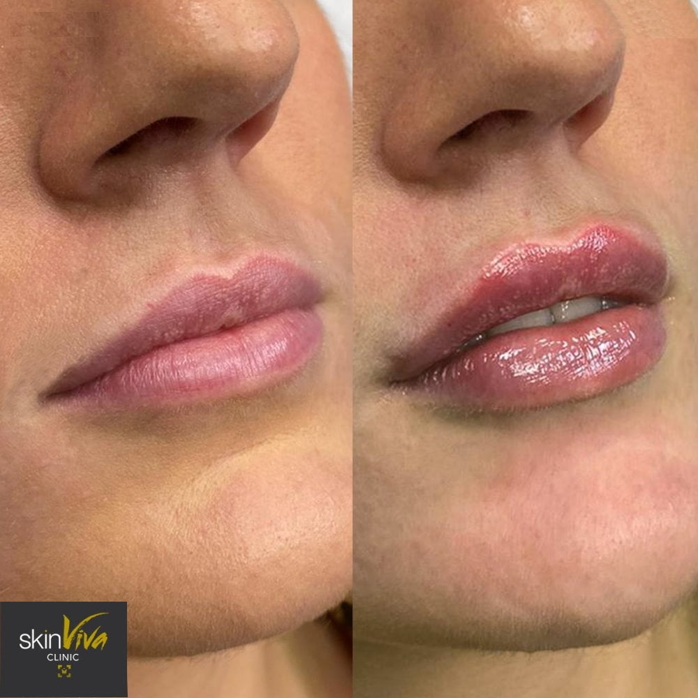 lips filler lips filler
