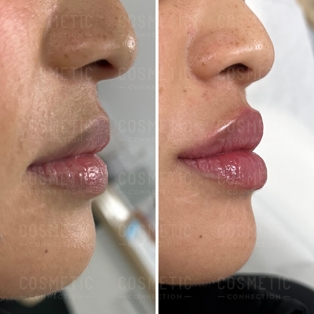 lips filler lips filler