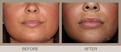 lips filler lips filler