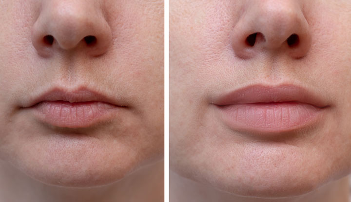 Lips Filler: Adding volume and shape