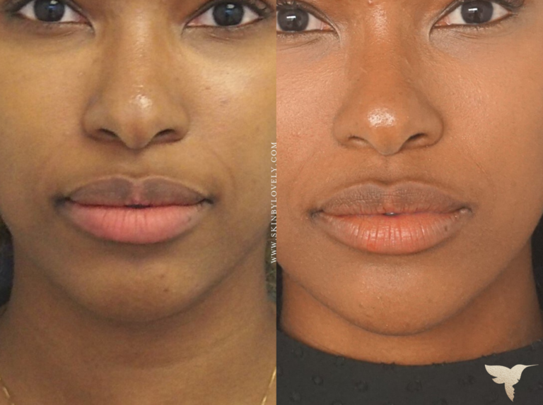 lips filler lips filler