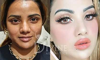 lips surgery