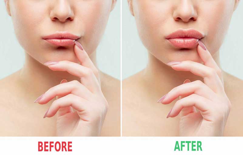 lips surgery