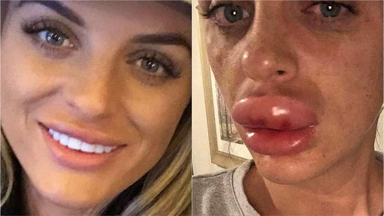 lips surgery