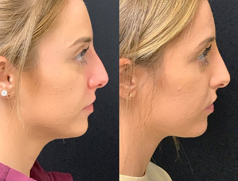 liquid rhinoplasty liquid rhinoplasty