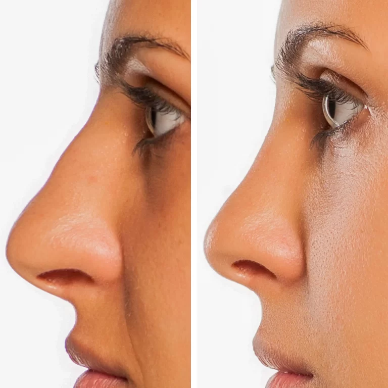 Liquid Rhinoplasty: A non-surgical approach to nose reshaping