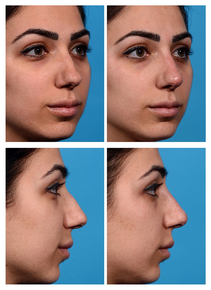 liquid rhinoplasty liquid rhinoplasty