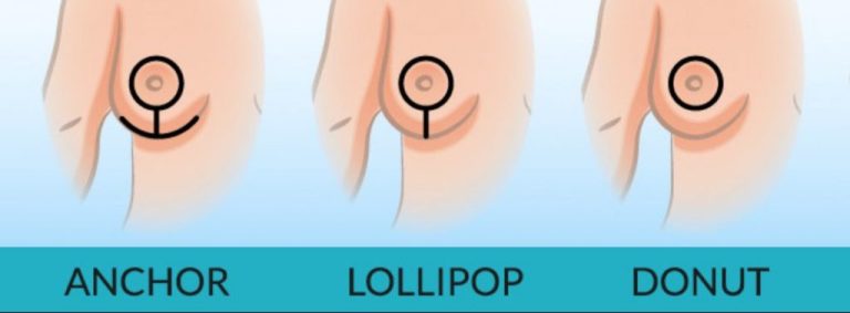 Lollipop Lift: A modern approach to breast lifting