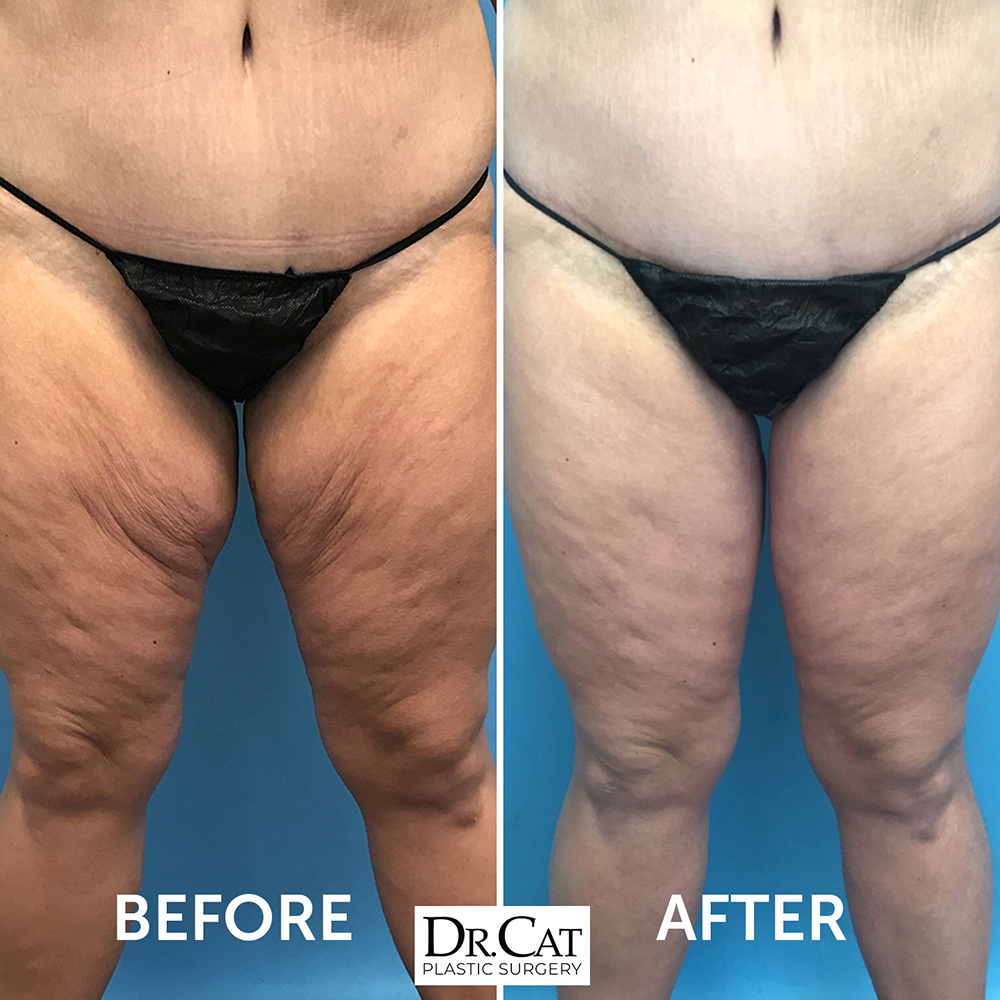 loose skin removal