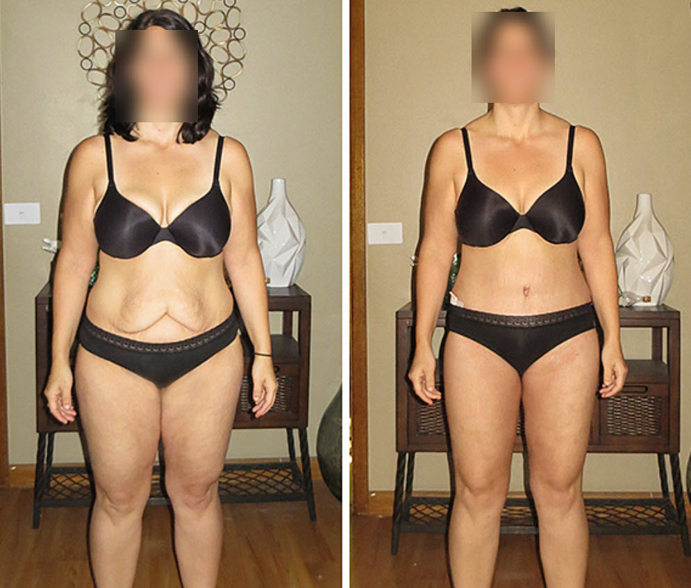 loose skin removal