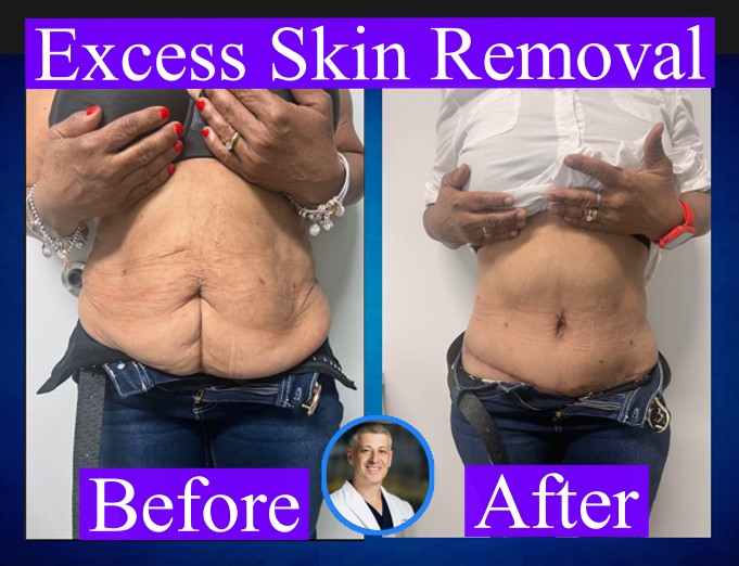 Loose skin removal: Restoring smooth, tight skin