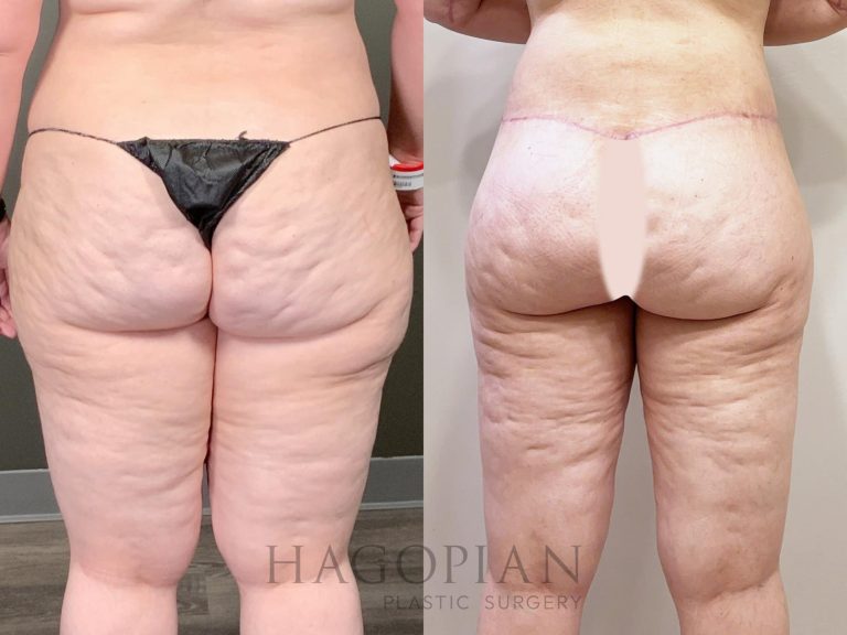 Lower body lift cost: Budgeting for a full-body transformation