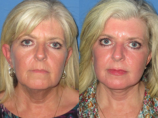 lower face lift lower face lift