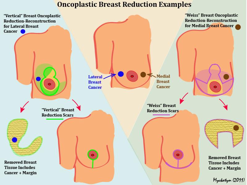 lumpectomy procedure