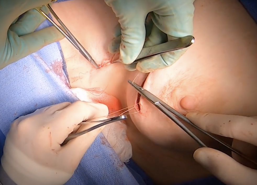 lumpectomy procedure