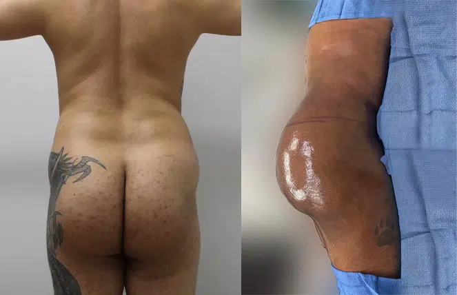 Male BBL: Sculpting the male physique