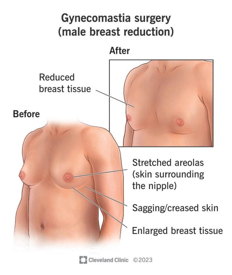 Male Gynecomastia: Treatment for enlarged male breasts