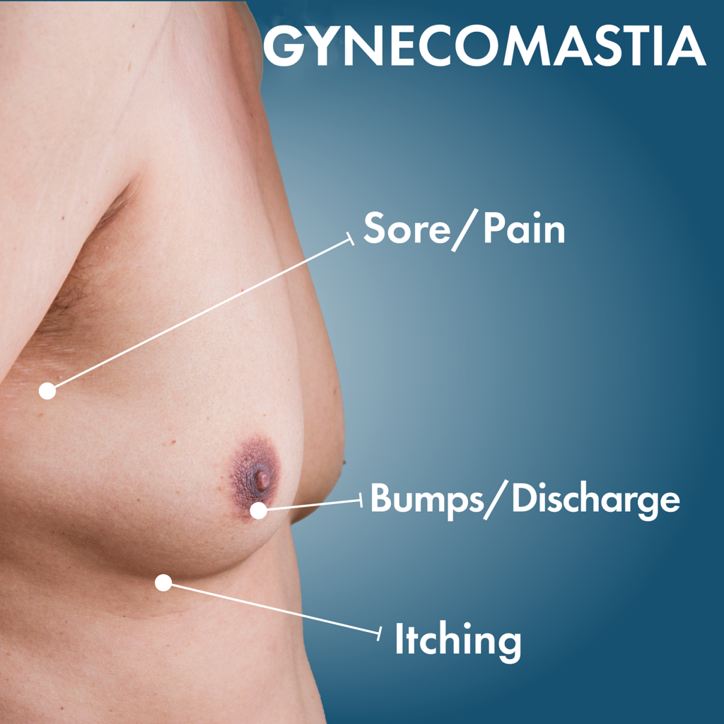 male gynecomastia male gynecomastia