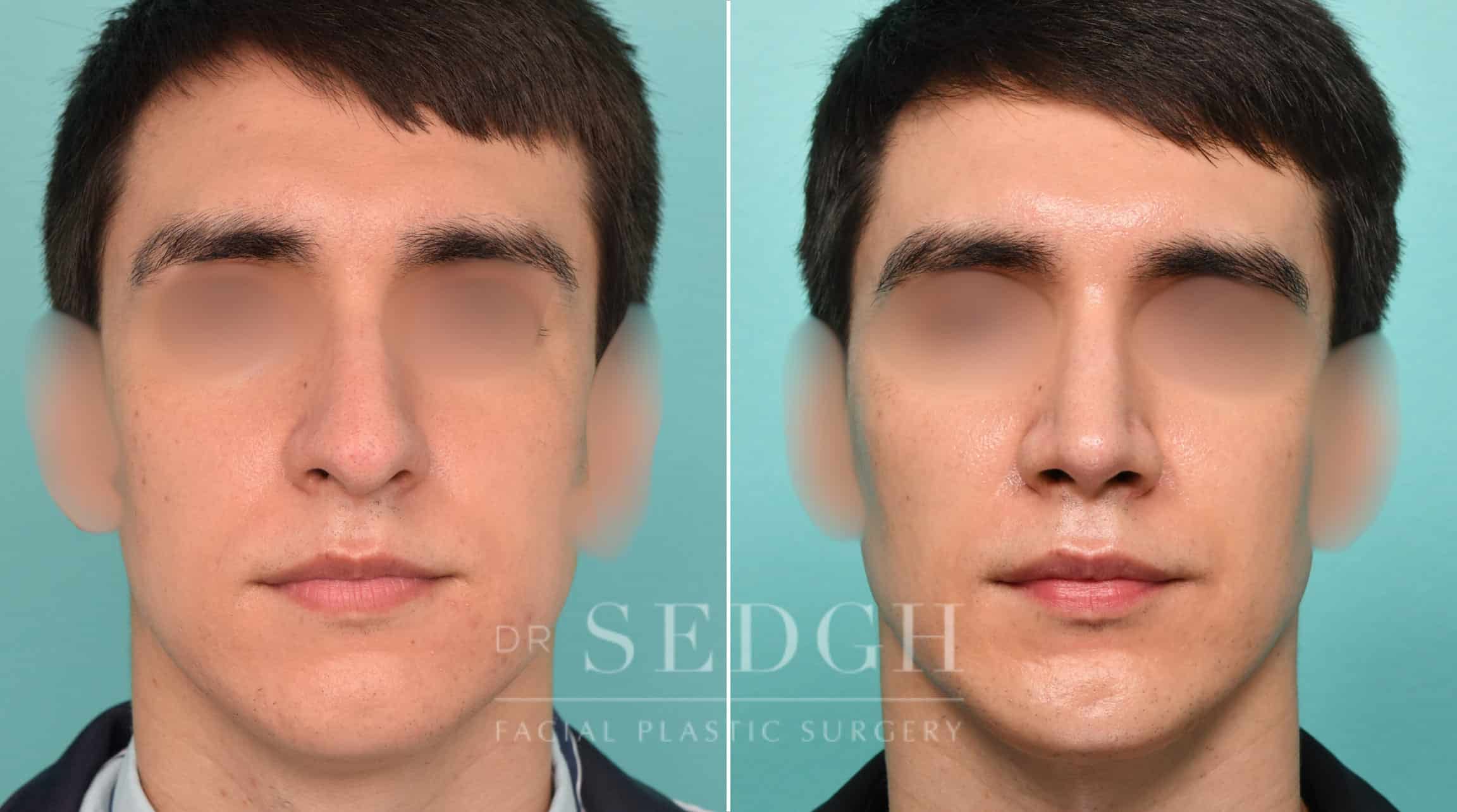 male rhinoplasty male rhinoplasty