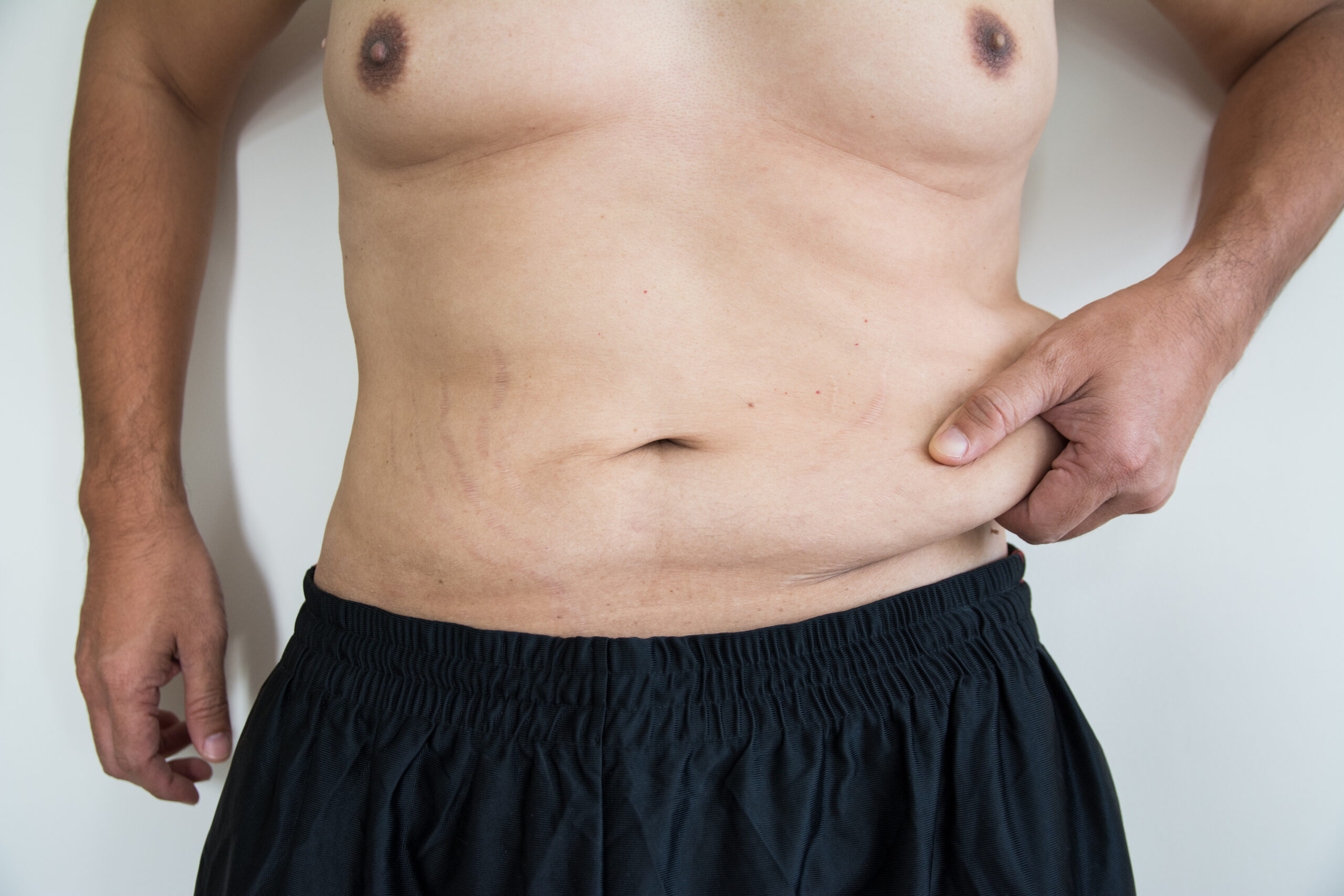 male tummy tuck male tummy tuck