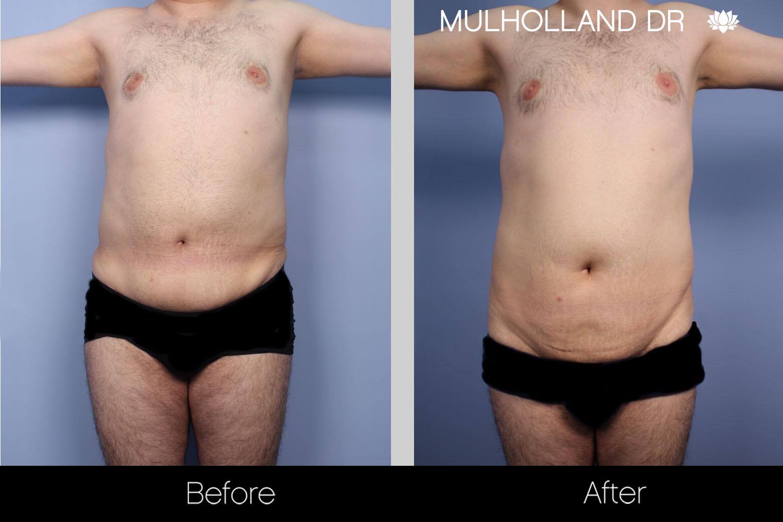 male tummy tuck male tummy tuck